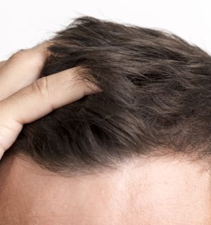 Hair Transplantation