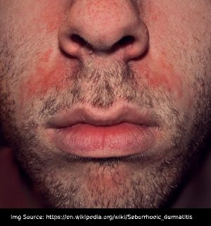 Seborrheic Dermatitis