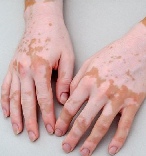 Vitiligo
