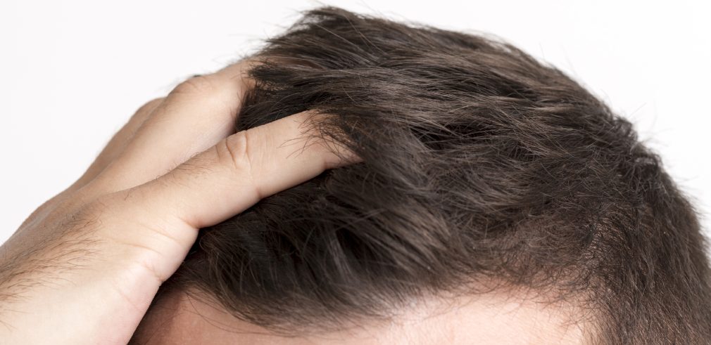 Hair Transplantation