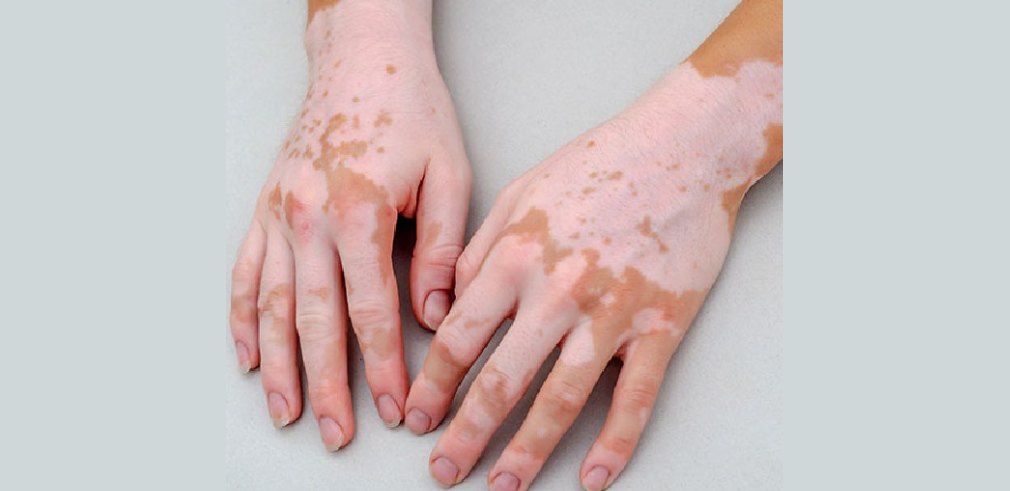 Vitiligo