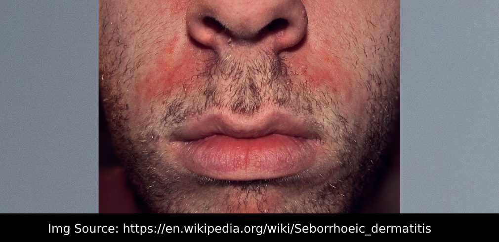 Seborrheic Dermatitis